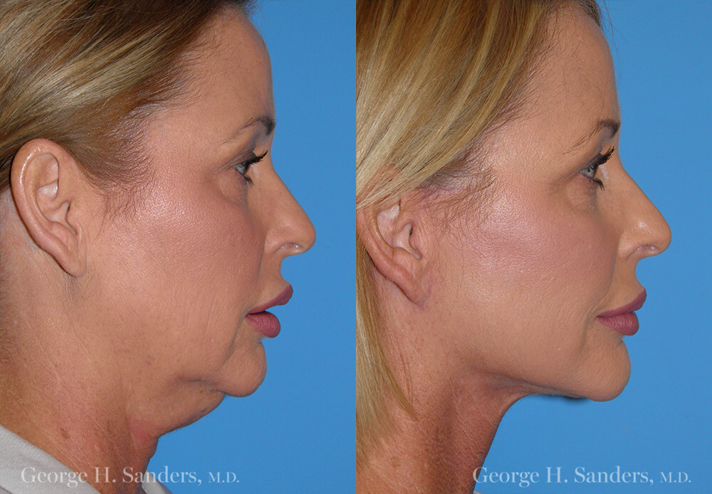 Before and After Result